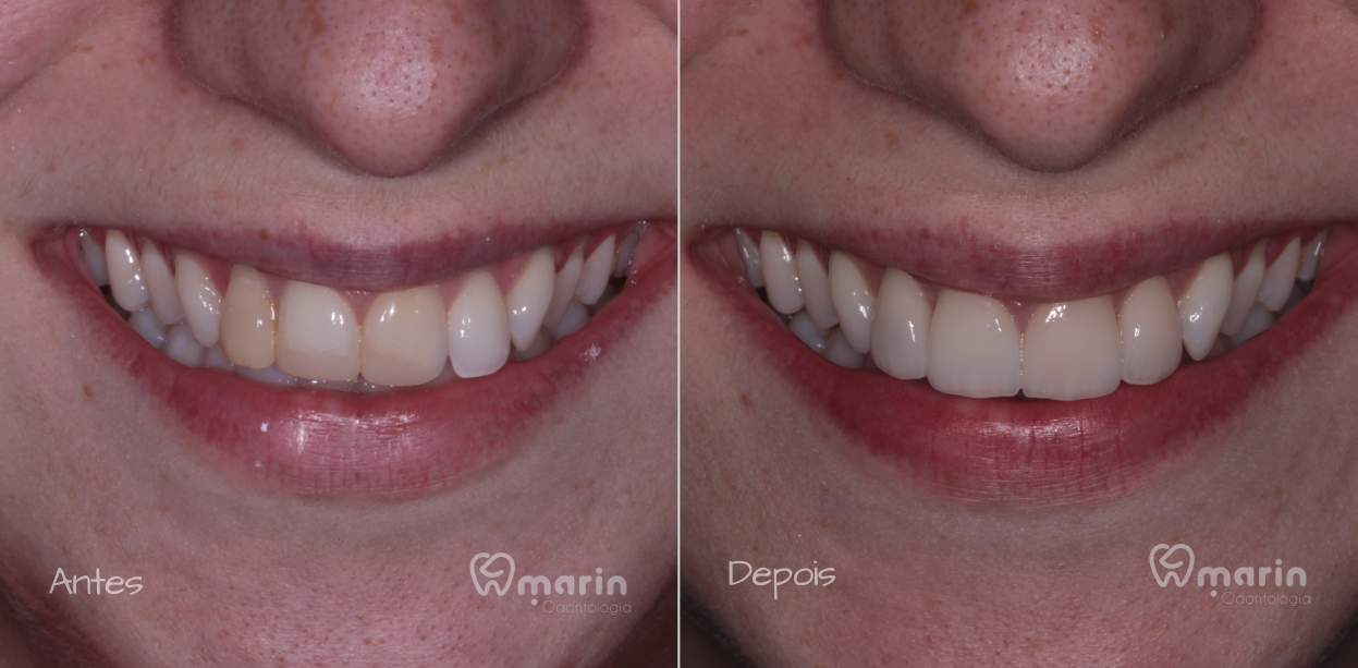 Facetas nos 4 anteriores