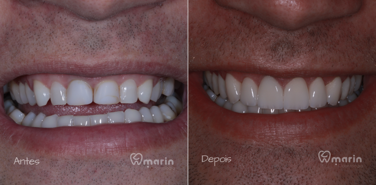 Lentes de Porcelana - 3