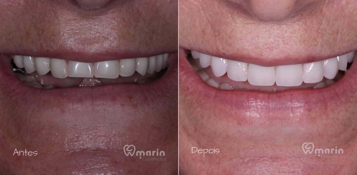 Protese sobre implantes