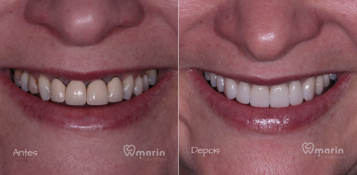 Reabilitação Estética