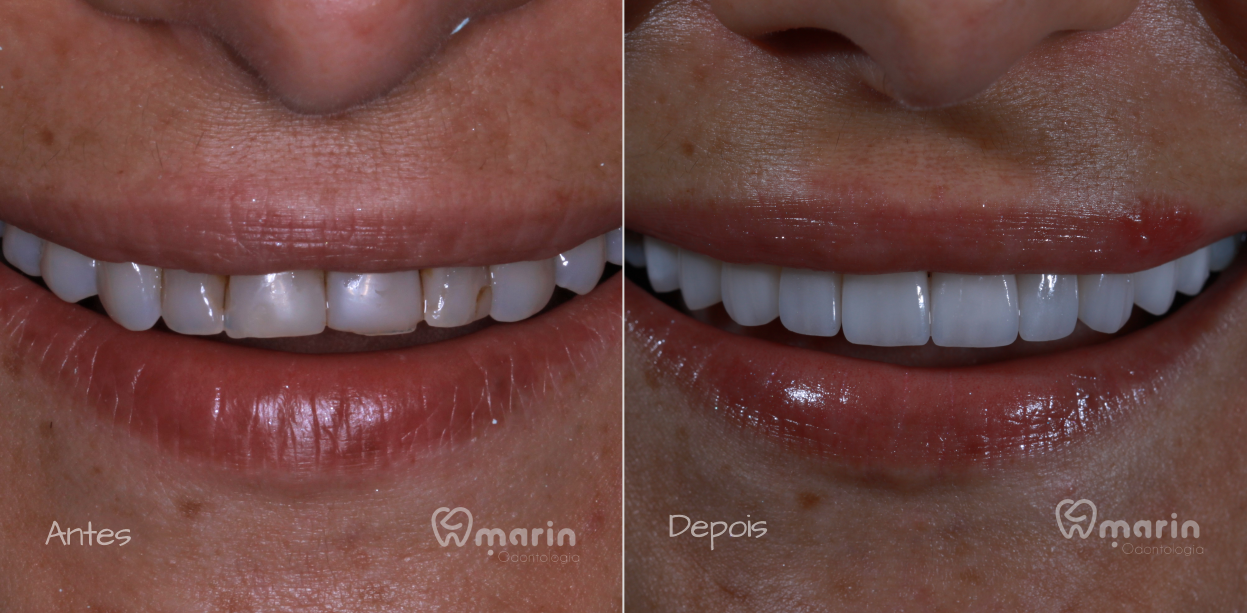 lentes de porcela - 1