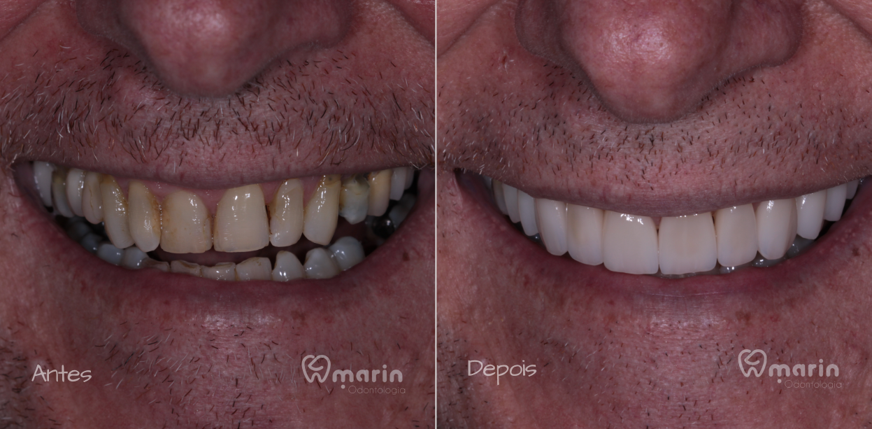 lentes de porcelana - 5